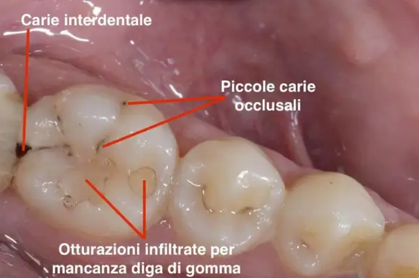 Dente con carie interdentale e piccole carie occlusali. Si nota un puntino nero sul dente, segno di un problema da affrontare.