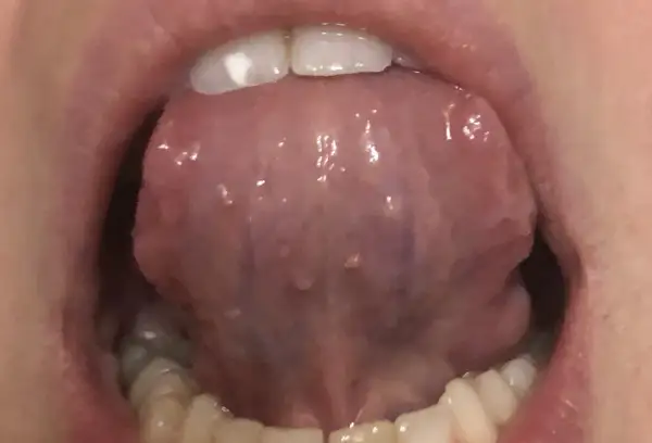 Lingua con piccole protuberanze, forse un papilloma sotto la lingua, visibile con i denti in primo piano.