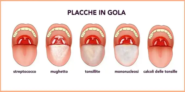 Illustrazione di cinque bocche aperte che mostrano diverse condizioni della gola, tra cui placche e calcoli tonsillari.