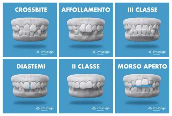 Modelli di denti con problemi: crossbite, affollamento, III classe, diastemi, II classe, morso aperto. Soluzioni Invisalign per correggere.