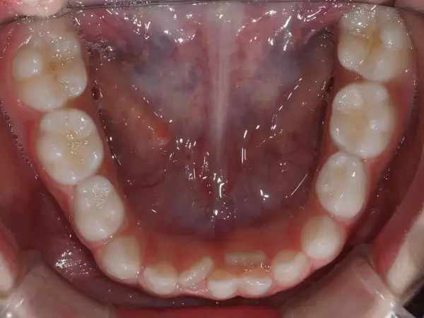 Vista ravvicinata della bocca di un adulto con denti sani, alcuni con piccole bollicine. Si nota una leggera sovrapposizione di alcuni denti, suggerendo una possibile necessità di correzione ortodontica per i denti doppia fila adulti.