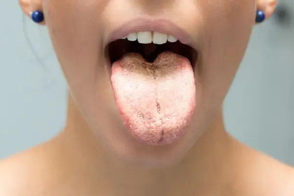 Lingua con patina biancastra, suggerisce sciacqui con bicarbonato per lingua per una pulizia profonda.
