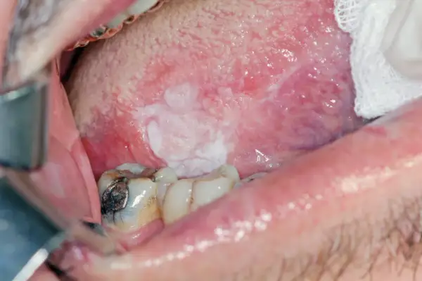 Lesione bianca sulla lingua, in attesa di biopsia escissionale.