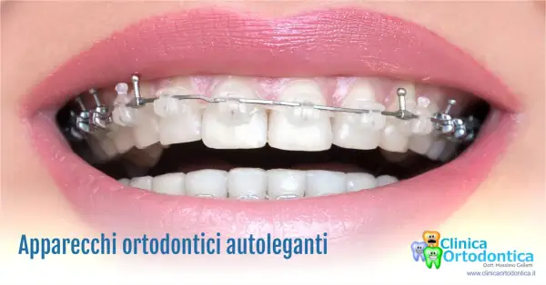 Primo piano di un sorriso con apparecchio autolegante trasparente e metallico.