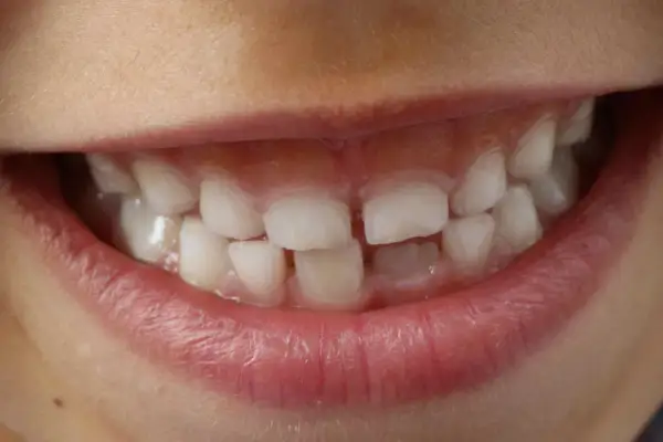 Denti con opacità e striature biancastre, segni di ipomineralizzazione denti, che rendono lo smalto più fragile.