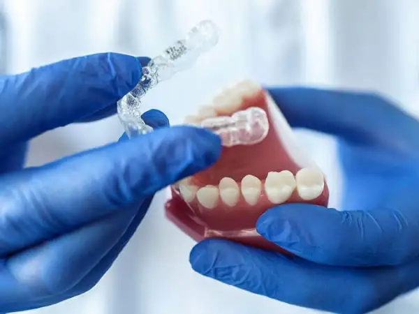 Mani guantate mostrano un bite notturno trasparente su un modello di denti.