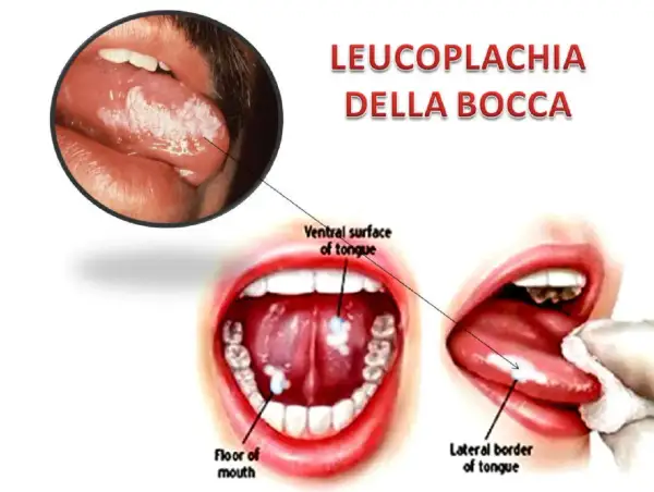 Leucoplachia della bocca: lesioni biancastre su lingua e pavimento orale. Non è una malattia che porta alla morte, ma un segnale da non sottovalutare.