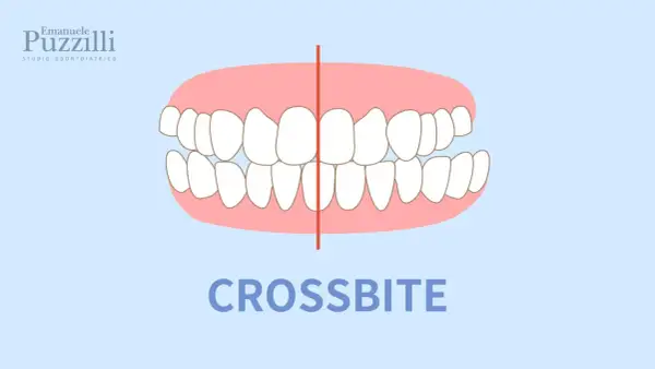 Illustrazione di un morso testa a testa, dove i denti superiori coprono quelli inferiori. Il termine "CROSSBITE" è scritto in basso.