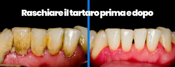 Denti con tartaro prima e dopo la pulizia. Scopri come pulire i denti dal tartaro a casa per un sorriso smagliante.