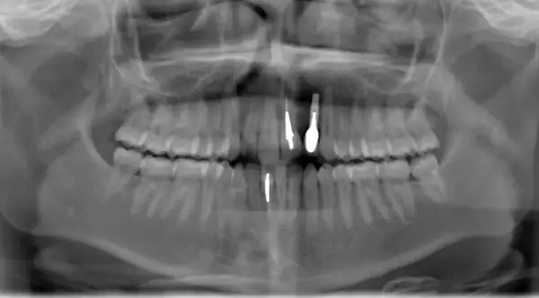 Radiografia panoramica dentale che mostra la sinfisi mandibolare con impianti dentali nella mascella e nella mandibola.