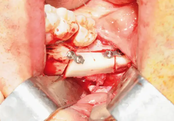 Chirurgia orale: frammento osseo fissato con placche metalliche, vicino al nervo alveolare.