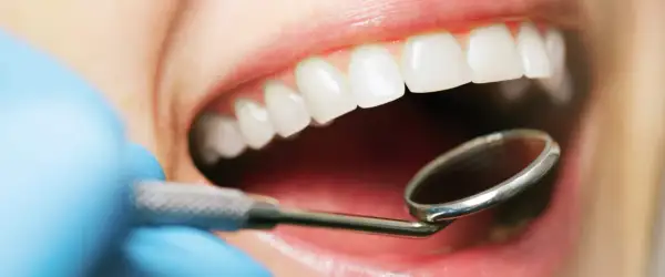 Esame del cavo orale con specchietto dentale. Si osservano denti bianchi e gengive sane, escludendo la presenza di stomatite palato.