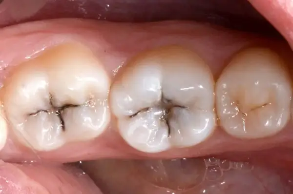 Denti con evidenti segni di carie, con aree scure e profonde che indicano un dente cariato.