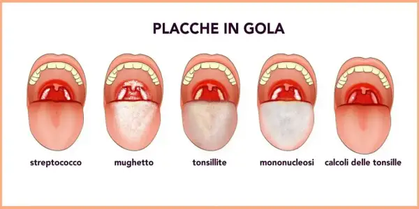 Illustrazione di diverse condizioni della gola, tra cui placche, mughetto e tonsillite, utili per comprendere i rimedi naturali per le placche in gola.
