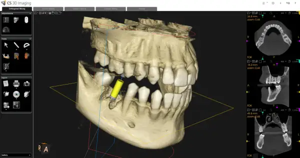 Visualizzazione 3D di un impianto dentale tramite cbct dentale. Sezioni assiali, coronali e sagittali mostrano dettagli ossei e dentali.