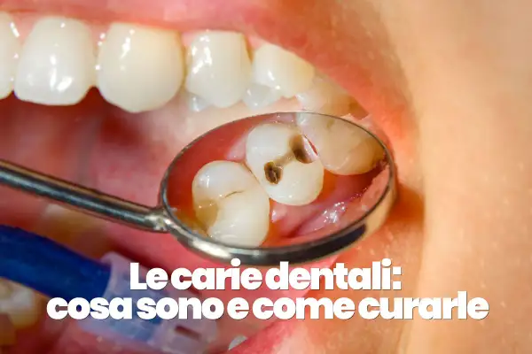 Dettaglio di denti con carie visibile in uno specchietto dentale. Scopri cosa sono le carie e come curare una carie a casa.