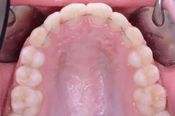 Denti dopo apparecchio con filo metallico di ritenzione. Un sorriso perfetto è il risultato di cure attente.