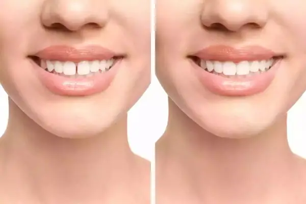 Prima e dopo: il diastema, ovvero lo spazio tra i denti, viene corretto per un sorriso perfetto.
