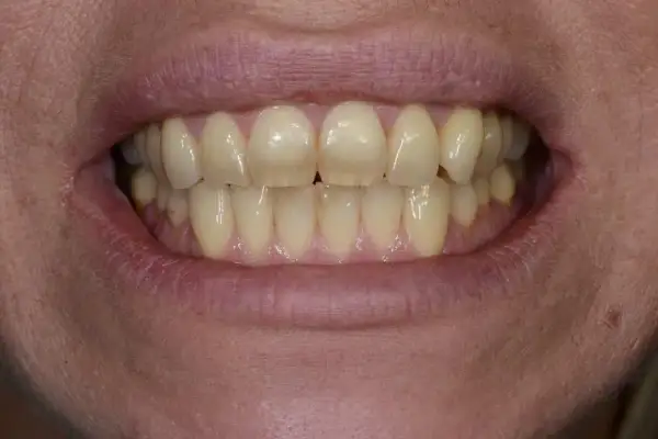 Denti ingialliti, forse a causa della clorexidina. La bocca è aperta, mostrando un sorriso.
