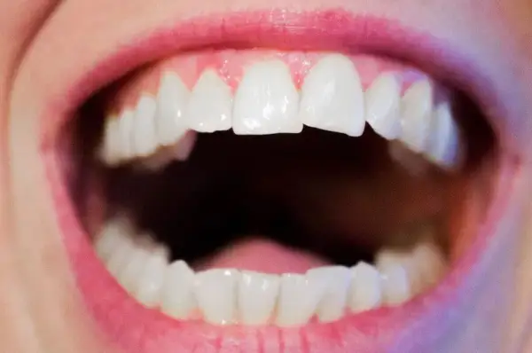 Bocca aperta con denti bianchi e ravvicinati, un esempio di affollamento dentale.