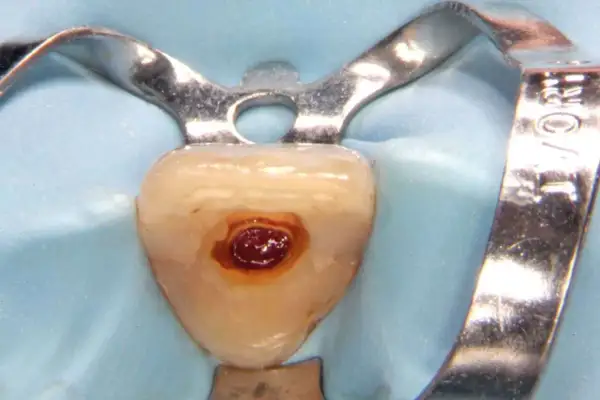 Dettaglio di un dente con cavità preparata per il cemento radicolare, isolato con diga di gomma e clamp metallico.