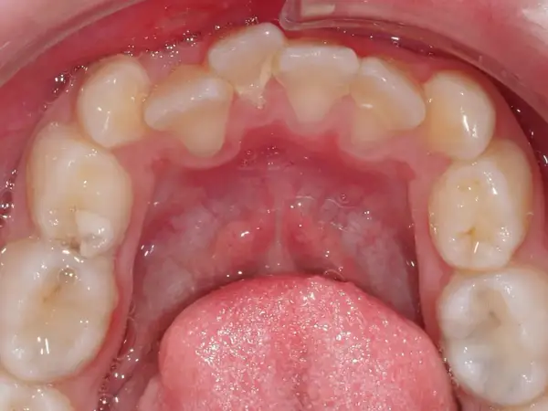 Vista ravvicinata dell'arcata dentale inferiore con evidente affollamento dentale inferiore. Si notano denti leggermente storti e sovrapposti.