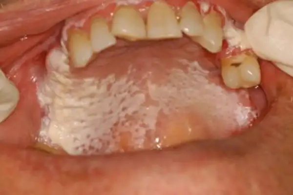 Leucoplachia palato: placche biancastre e irregolari sul palato, con aree rosse e puntini.