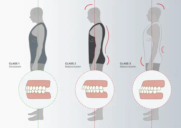 Illustrazione della classificazione di angle: Class 1 (occlusione corretta), Class 2 e Class 3 (malocclusioni) con dettagli dentali.