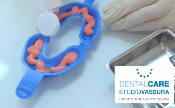 Applicazione di gel per fluoro profilassi in un portaimpronte dentale.