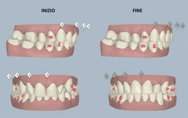 Confronto tra denti prima e dopo il trattamento ortodontico, con evidenziati gli attachment Invisalign.
