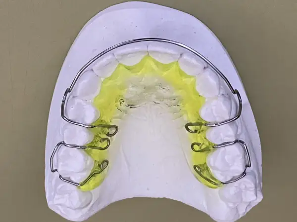 Modello di gesso con una placca di Hawley colorata di giallo, pronta per correggere l'allineamento dentale.