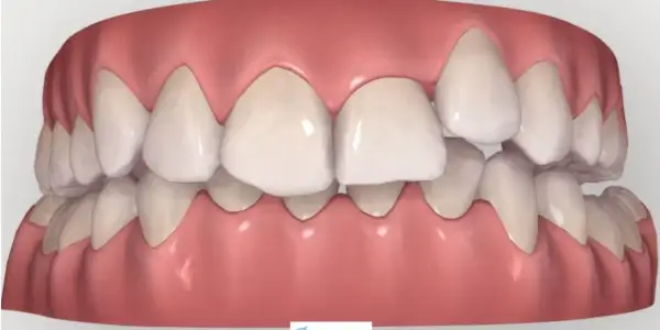 Arcata dentale con un dente storto in evidenza, che necessita di correzione ortodontica per un sorriso perfetto.