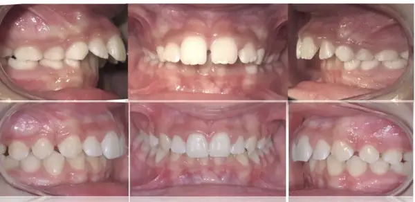 Denti sporgenti prima e dopo: vista laterale e frontale di un sorriso con denti allineati e corretti.