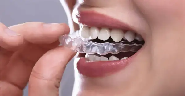 Dita inseriscono un bite dentale trasparente per rilassare la muscolatura.