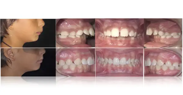 Prima e dopo: correzione di denti a castoro e malocclusioni.