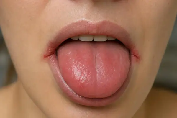 Lingua fumatore con labbra screpolate e arrossate, forse a causa del fumo.
