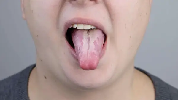 Lingua strana dopo antibiotico, con patina bianca e striature rosate.