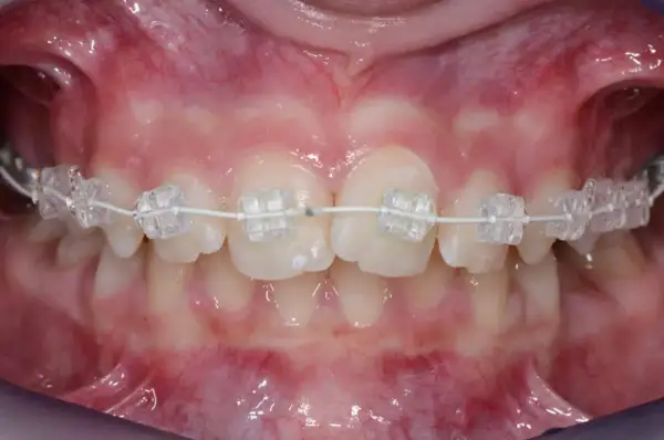 Primo piano di denti con apparecchio trasparente. Il filo bianco collega i bracket, mostrando il progresso del trattamento ortodontico e suggerendo ogni quanto si cambia il filo dell'apparecchio.