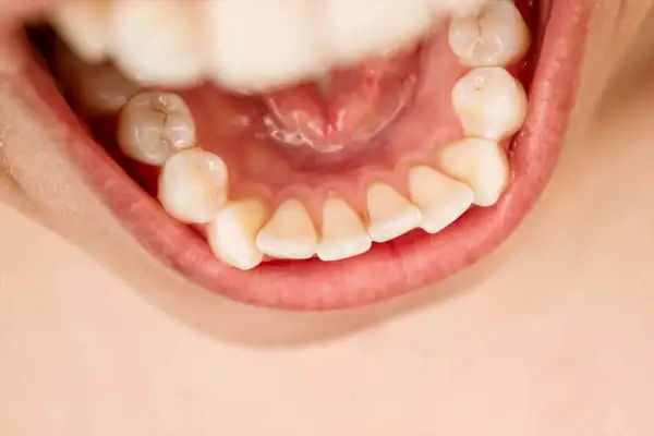 Denti ingialliti e con accumuli di tartaro, un rischio che fa cadere i denti.