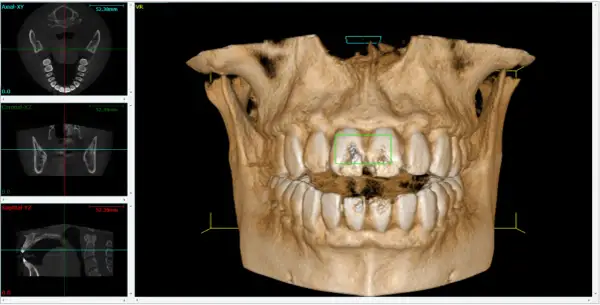 Vista 3D di denti con evidenziate aree di interesse. Si nota il canale naso palatino nelle sezioni assiale e coronale.