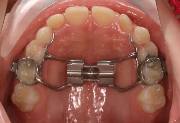 Espansore palatino con bite block ortodonzia. Strumento metallico per allargare il palato, fissato ai denti.