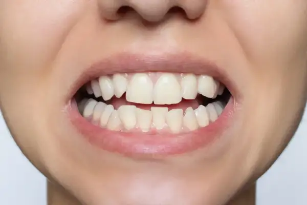 Primo piano di un sorriso con denti leggermente disallineati, che suggerisce la ricerca di malocclusione dentale rimedi.