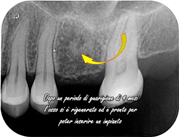 Radiografia dentale mostra rigenerazione ossea dopo displasia cemento ossea, pronta per impianto.