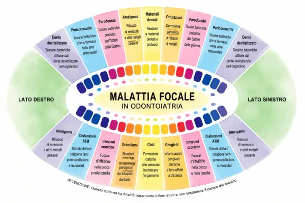 Schema sulla malattia focale in odontoiatria: denti devitalizzati, parodontite, amalgama e altri problemi legati ai **quadranti denti**.