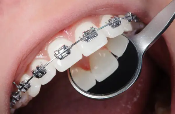 Dettaglio di denti con apparecchio ortodontico metallico. Un piccolo specchietto riflette i denti, mostrando come si mette l'apparecchio.
