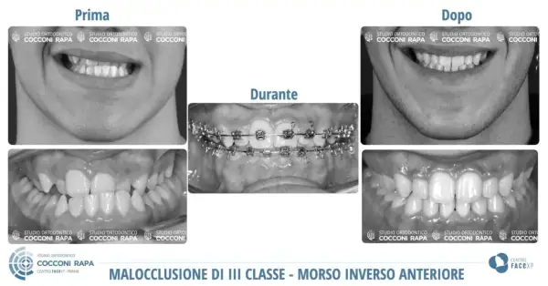Prima e dopo un trattamento ortodontico per correggere una malocclusione dentale e problemi neurologici correlati.