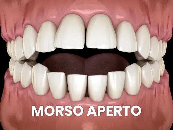 Denti con morso aperto. Si può mettere l'apparecchio anche avendo degli impianti dentali per correggere questa malocclusione.