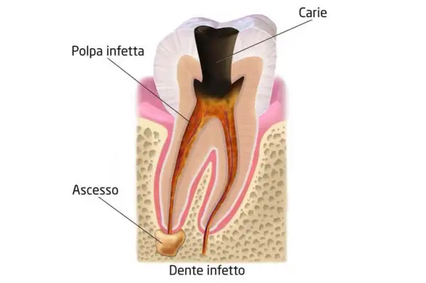 Dente infetto con carie e polpa infetta. Si nota un ascesso alla radice, segno di un'infezione avanzata.