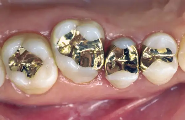 Denti con otturazioni in oro, fase di preparazione intarsio dentale.