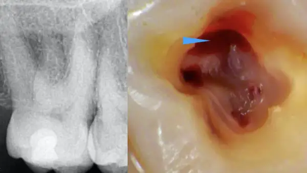 Radiografia e ingrandimento del primo molare superiore con polpa esposta e sanguinante, indicata da una freccia blu.